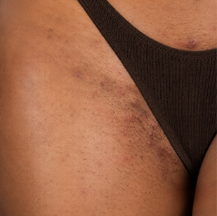 Bumps, Irritation & Ingrowns.
